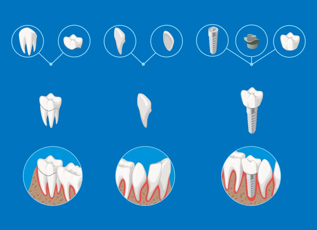types of dental implants