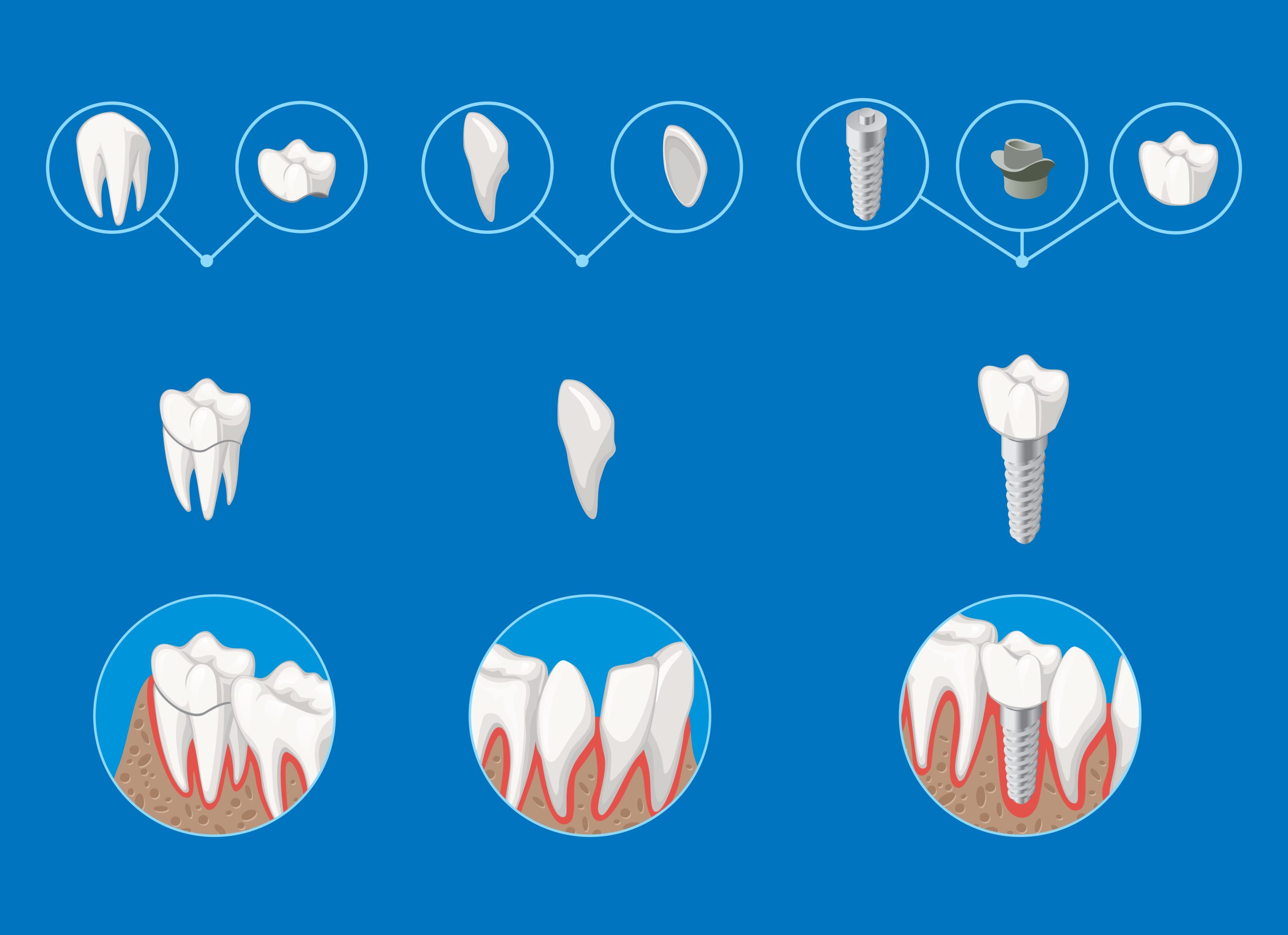 types of dental implants