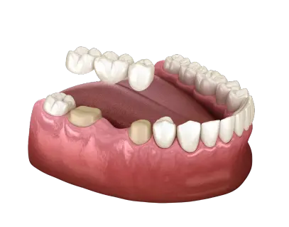 Dental Bridges