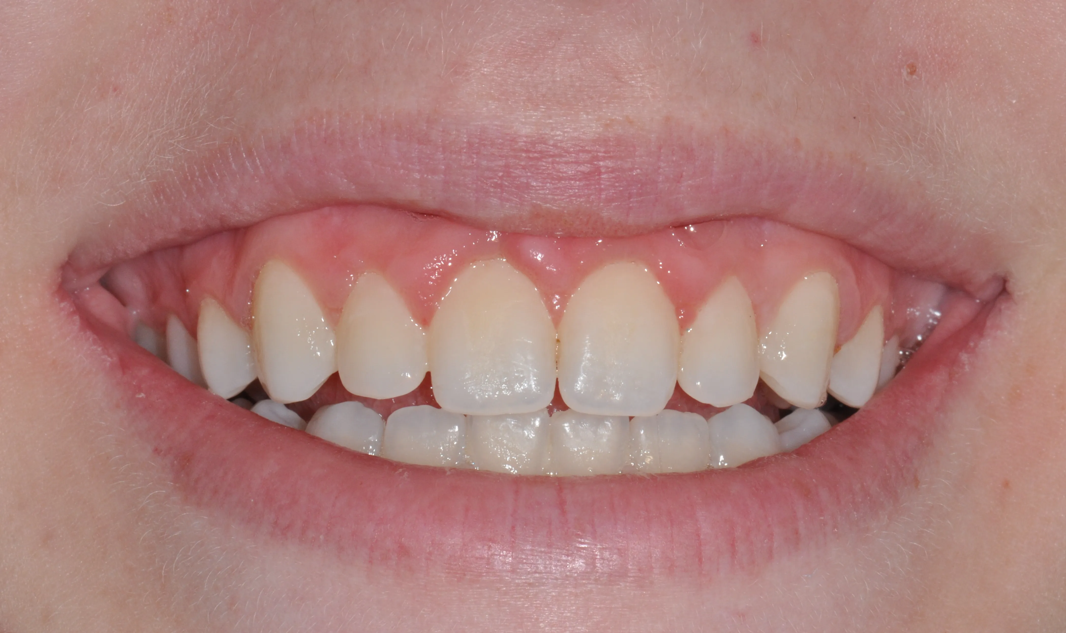 Esthetic Crown Lengthening After​