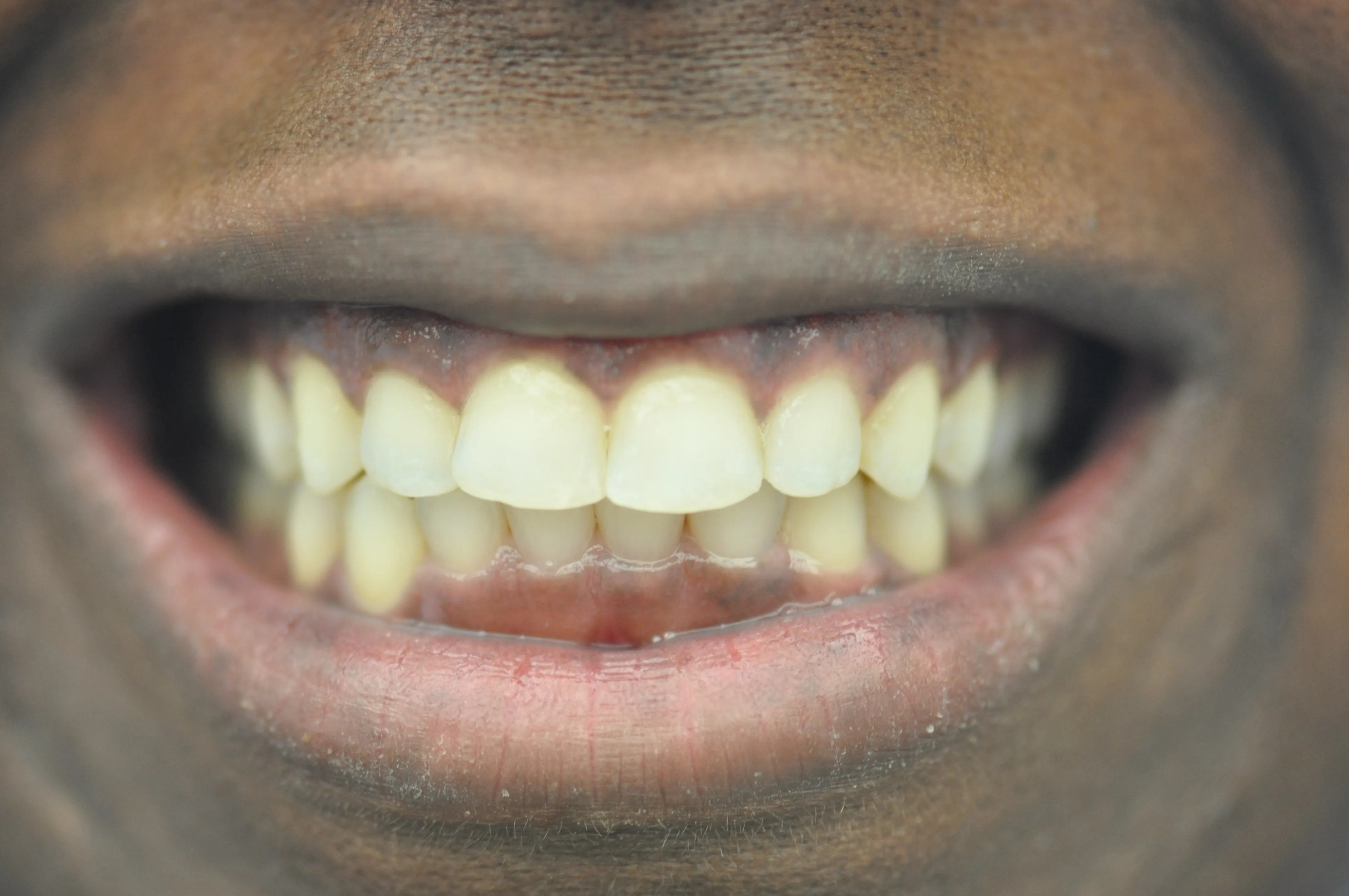 Esthetic Crown Lengthening Before​