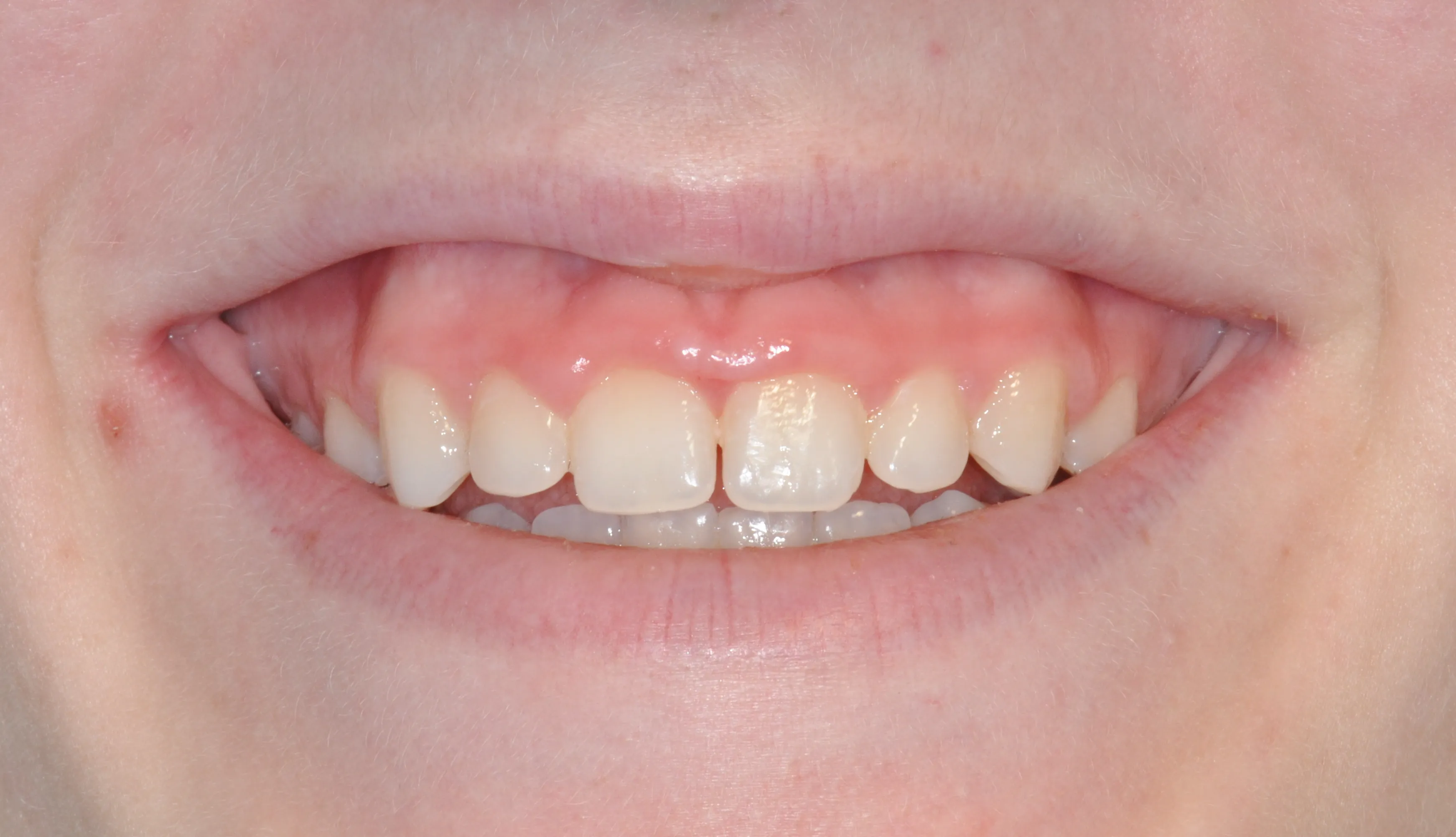 Esthetic Crown Lengthening Before​