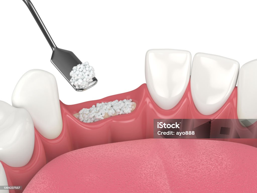 Dental Bone Graft
