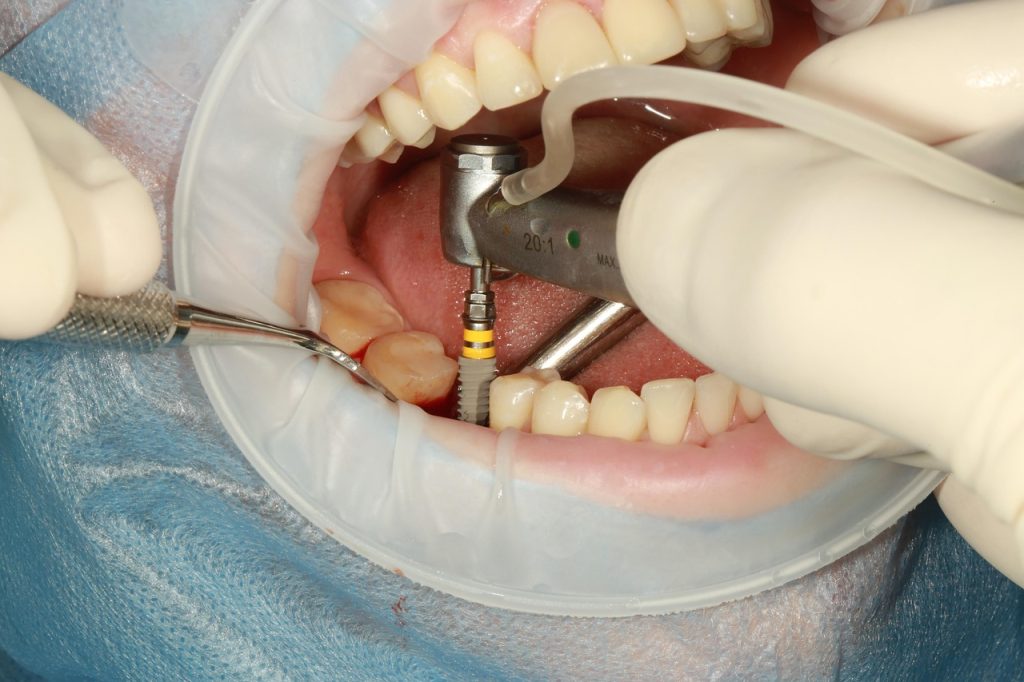 molar teeth implant​
