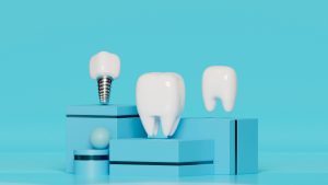 how do you clean dental implants